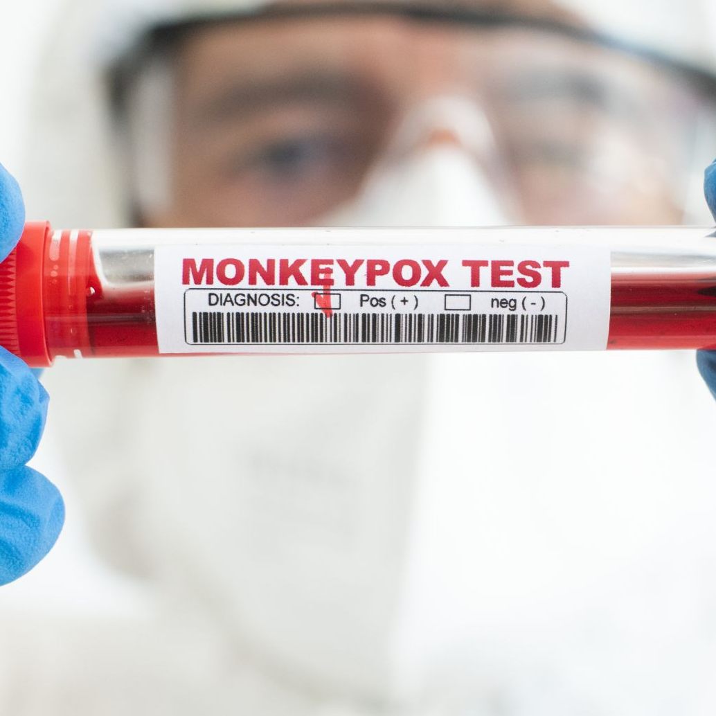 Laut einer Studie zirkuliert das Affenpocken-Virus schon länger unter Menschen, als gedacht.