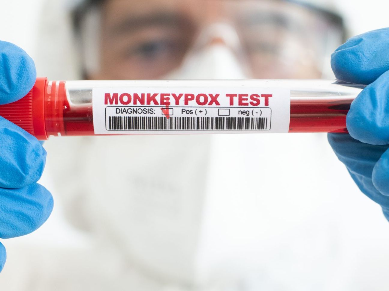 Laut einer Studie zirkuliert das Affenpocken-Virus schon länger unter Menschen, als gedacht.
