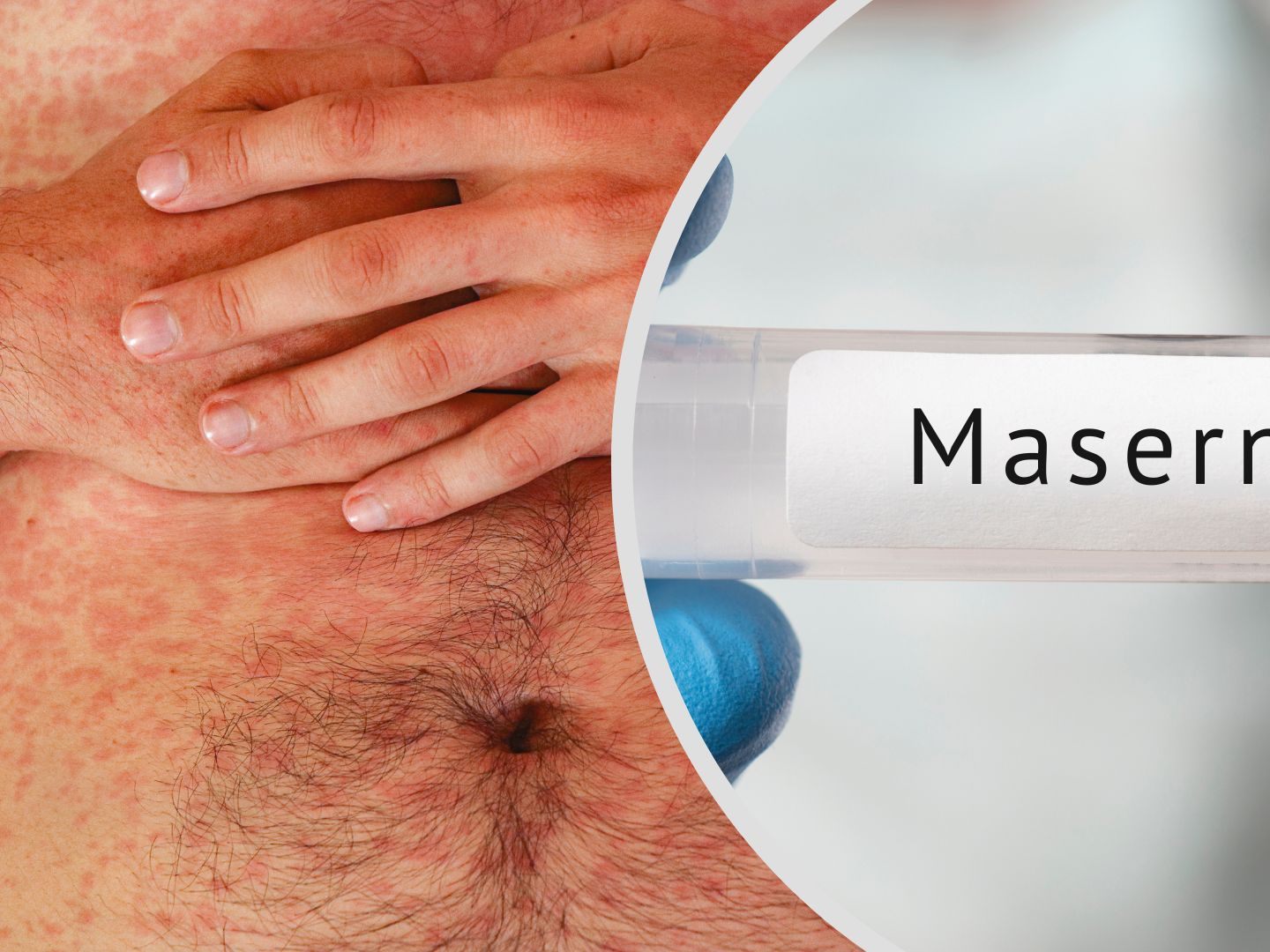 Zweiter Masern-Fall in Dornbirn