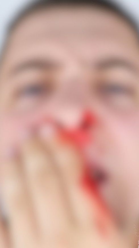 Ein Opfer wurde schwer verletzt und erlitt einen Nasenbeinbruch.