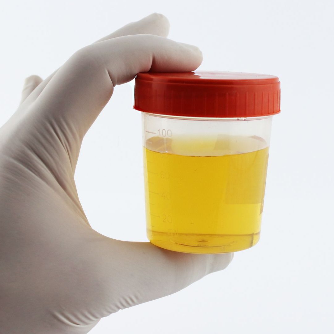 In Urinproben lassen sich Biomarker zu Long Covid ablesen.