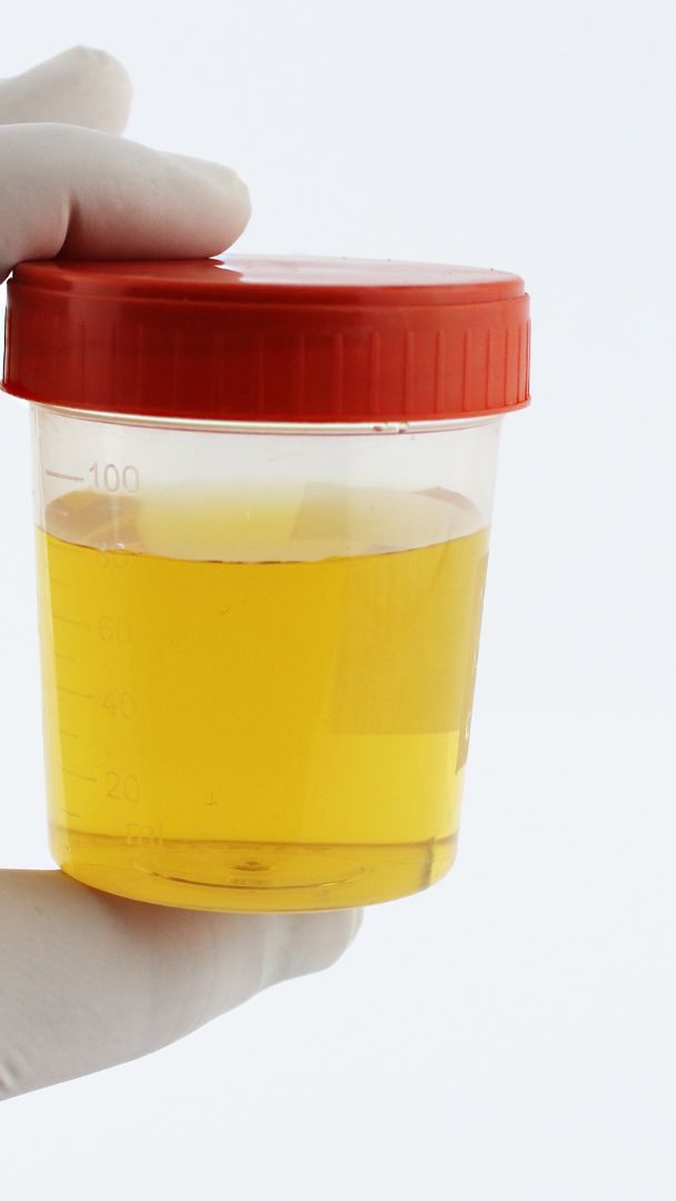 In Urinproben lassen sich Biomarker zu Long Covid ablesen.