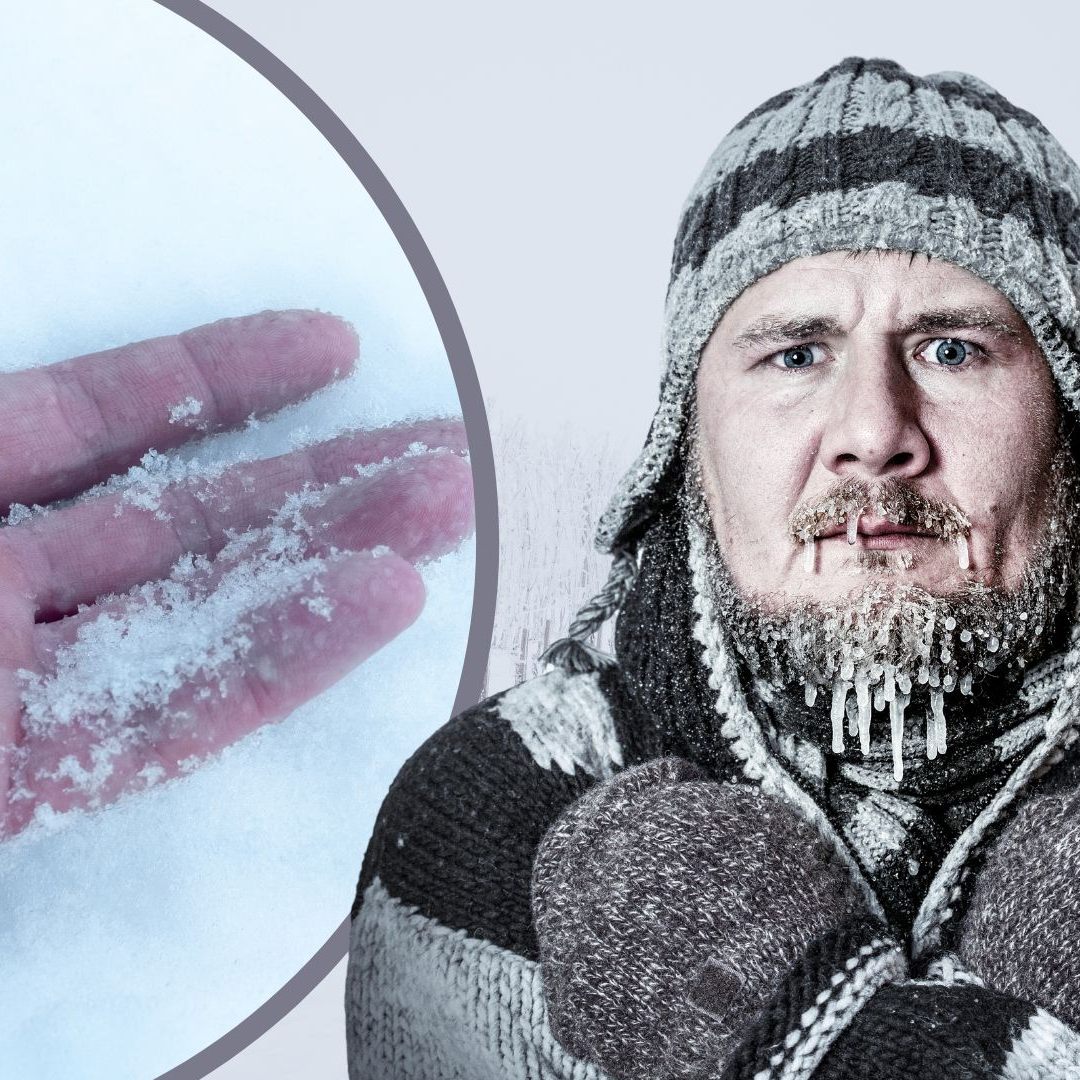 Erstes Medikament gegen schwere Erfrierungen