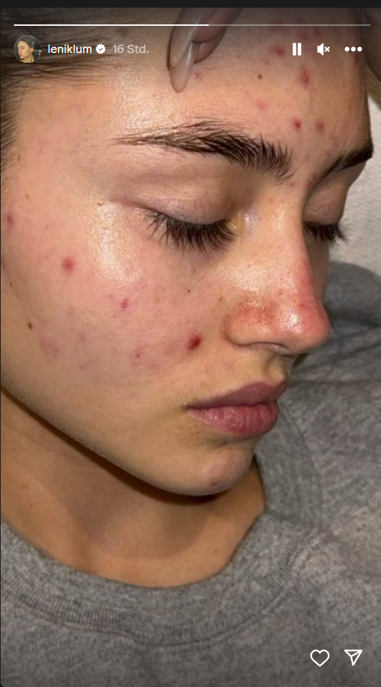 Leni Klum teilt auf Instagram ihre Probleme mit Akne Leni Klum teilt auf Instagram ihre Probleme mit Akne