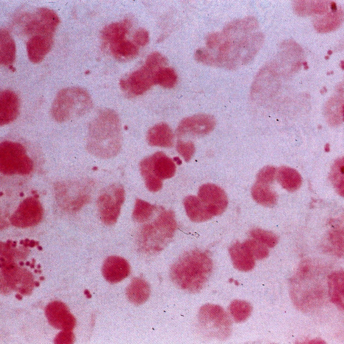 Einen Meningokokkenfall gibt es im Mühlviertel.