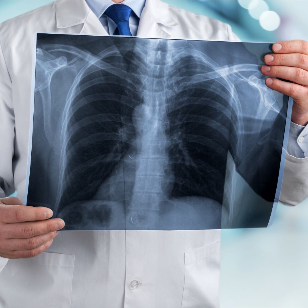 Bessere Chancen für Lungenkrebspatienten im Frühstadium.