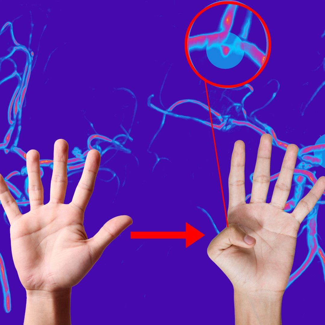 Anzeichen für Aortenaneurysma durch simplen Daumen-Test erkennen