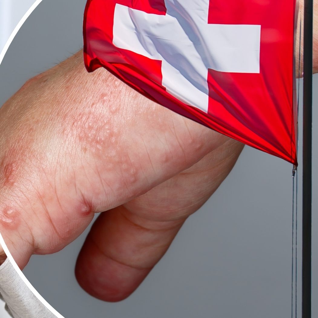 Zahlreiche Fälle der Krätze traten auch im Kanton St. Gallen auf. (Symbolbild)