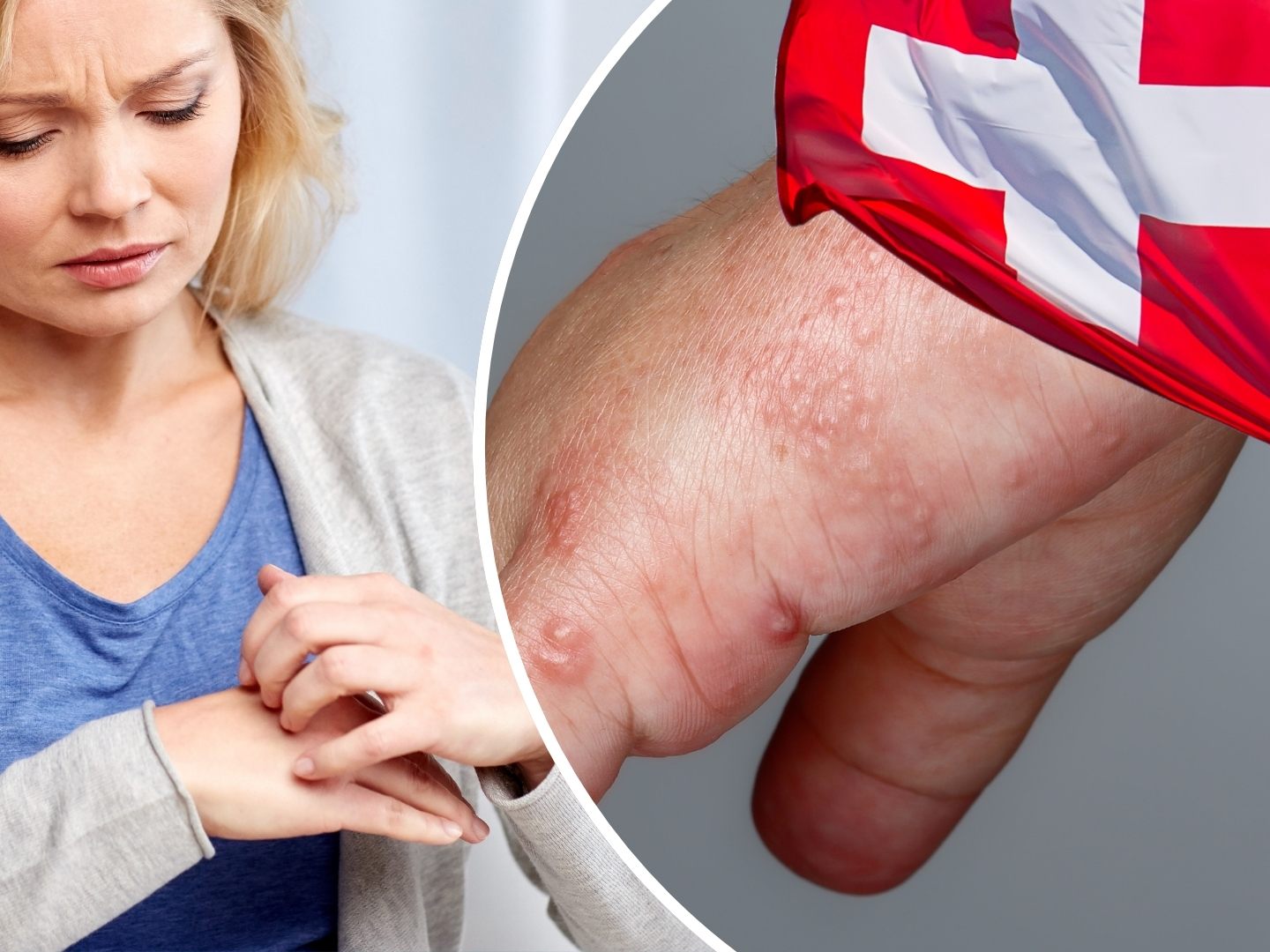 Zahlreiche Fälle der Krätze traten auch im Kanton St. Gallen auf. (Symbolbild)