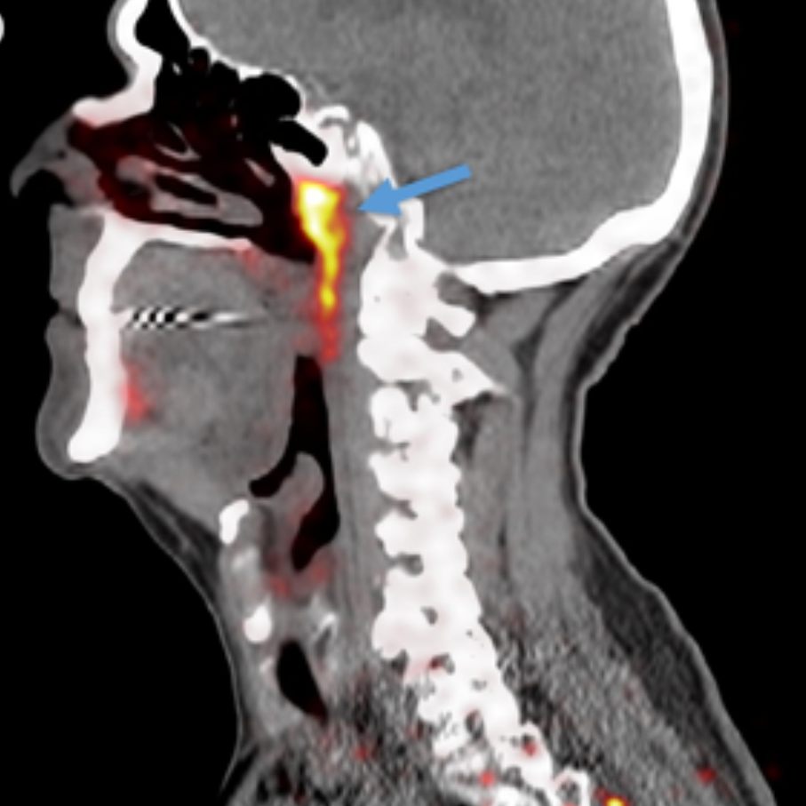 Im Kopfbereich des menschlichen Körpers befinden sich drei weitere bedeutende Paare von Speicheldrüsen.