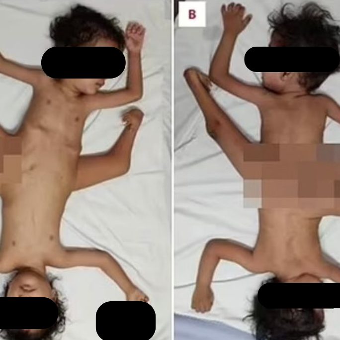 Die beiden Jungen wurden operiert.