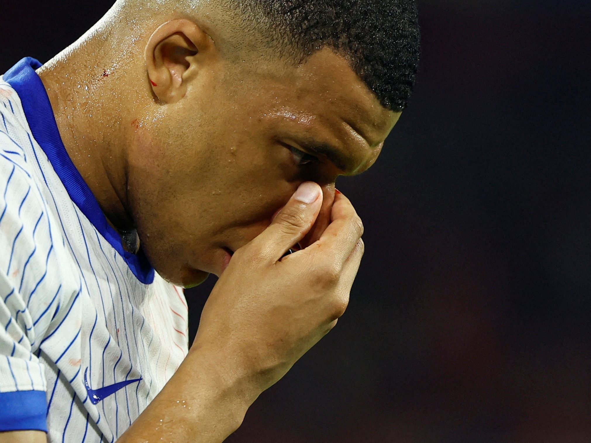 Der Nasenbeinbruch von Mbappe wurde bestätigt. Der Nasenbeinbruch von Mbappe wurde bestätigt.