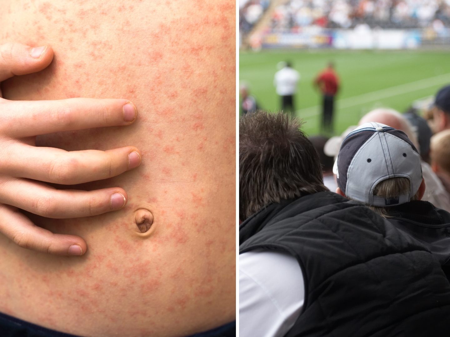 Zuschauer von Fußballmatch war an Masern erkrankt. (Symbolbild)