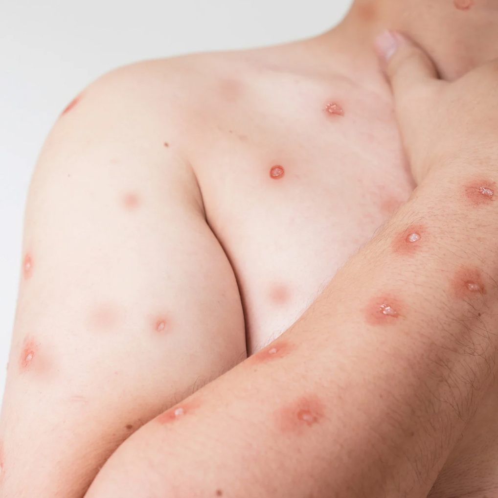 Die Virusvariante “Klade Ib” verursacht stärkere Symptome als die vorherige Variante Klade II.