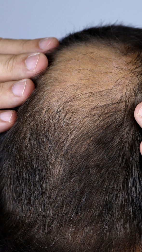 Eine Studie aus China hat einen möglichen Zusammenhang zwischen dem hohen Konsum von zuckerhaltigen Getränken und Haarausfall bei jungen Männern entdeckt.