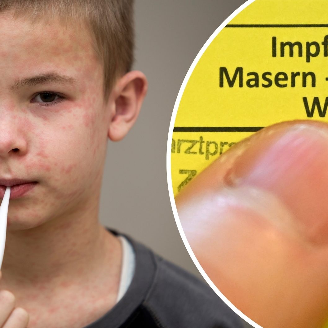 Impfung schützt vor Erkrankung, besonders bei Masern.