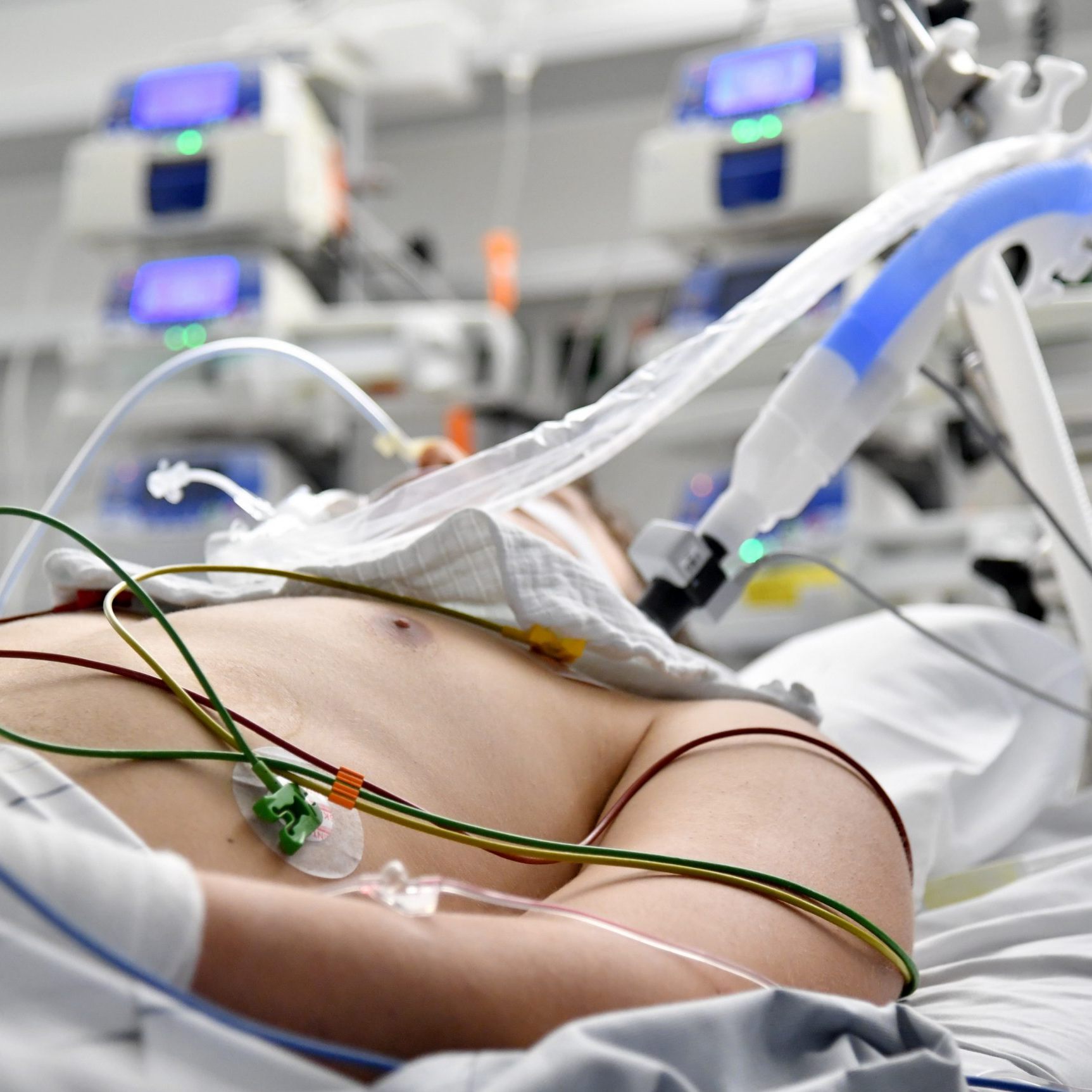 Die Zahl der Hospitalisierten aufgrund von Lungenentzündungen wegen Corona-Infektionen nimmt zu.