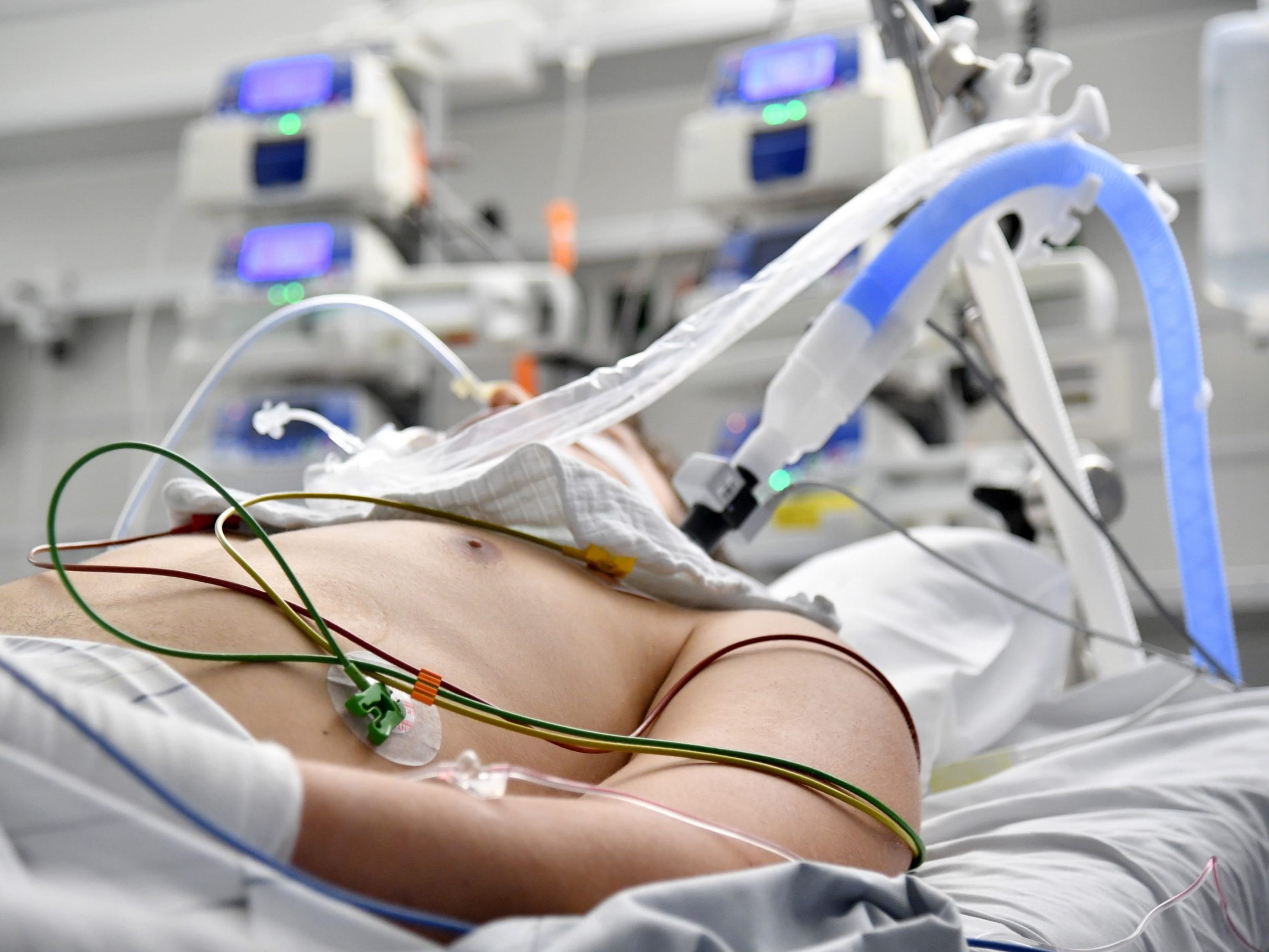 Die Zahl der Hospitalisierten aufgrund von Lungenentzündungen wegen Corona-Infektionen nimmt zu. Die Zahl der Hospitalisierten aufgrund von Lungenentzündungen wegen Corona-Infektionen nimmt zu.