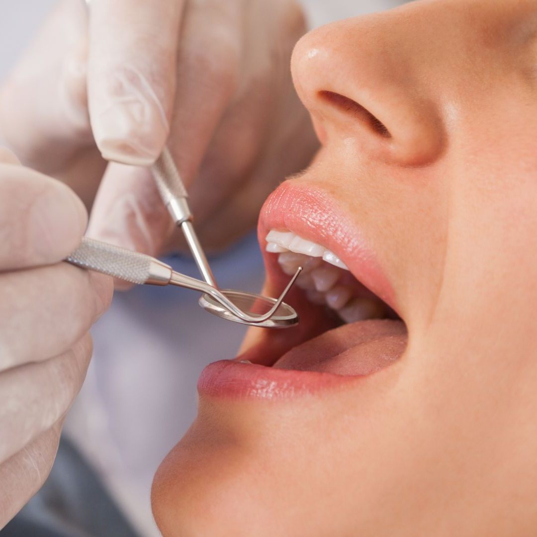 Die ÖGK setzt bei Zahnfüllungen auf Alternativen zu Amalgam.