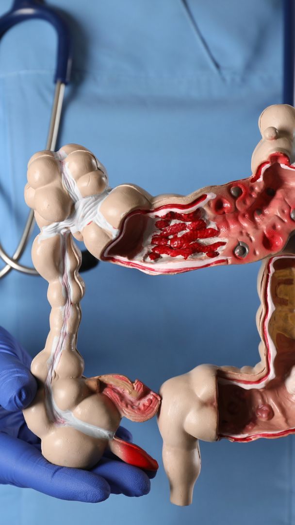 Mit einer Koloskopie kann Darmkrebs vorgebeugt werden.