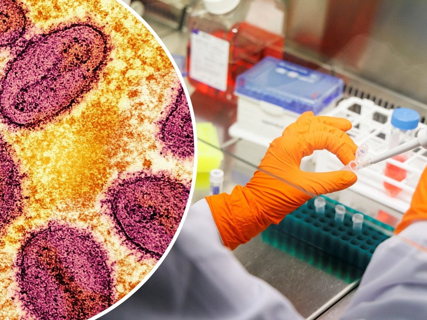 Im Nachbarland wurde erstmal die neue Variante des Mpox-Virus nachgewiesen.