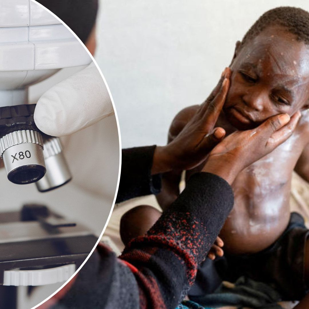 Das Gesundheitswesen des Landes kämpft bereits seit Monaten mit einem Ausbruch der Krankheit Mpox.