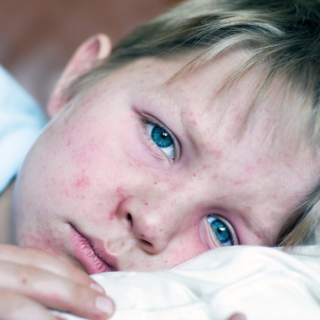 Gesundheitslandesrätin Martina Rüscher: Impfung schützt vor Masern. (Symbolbild)