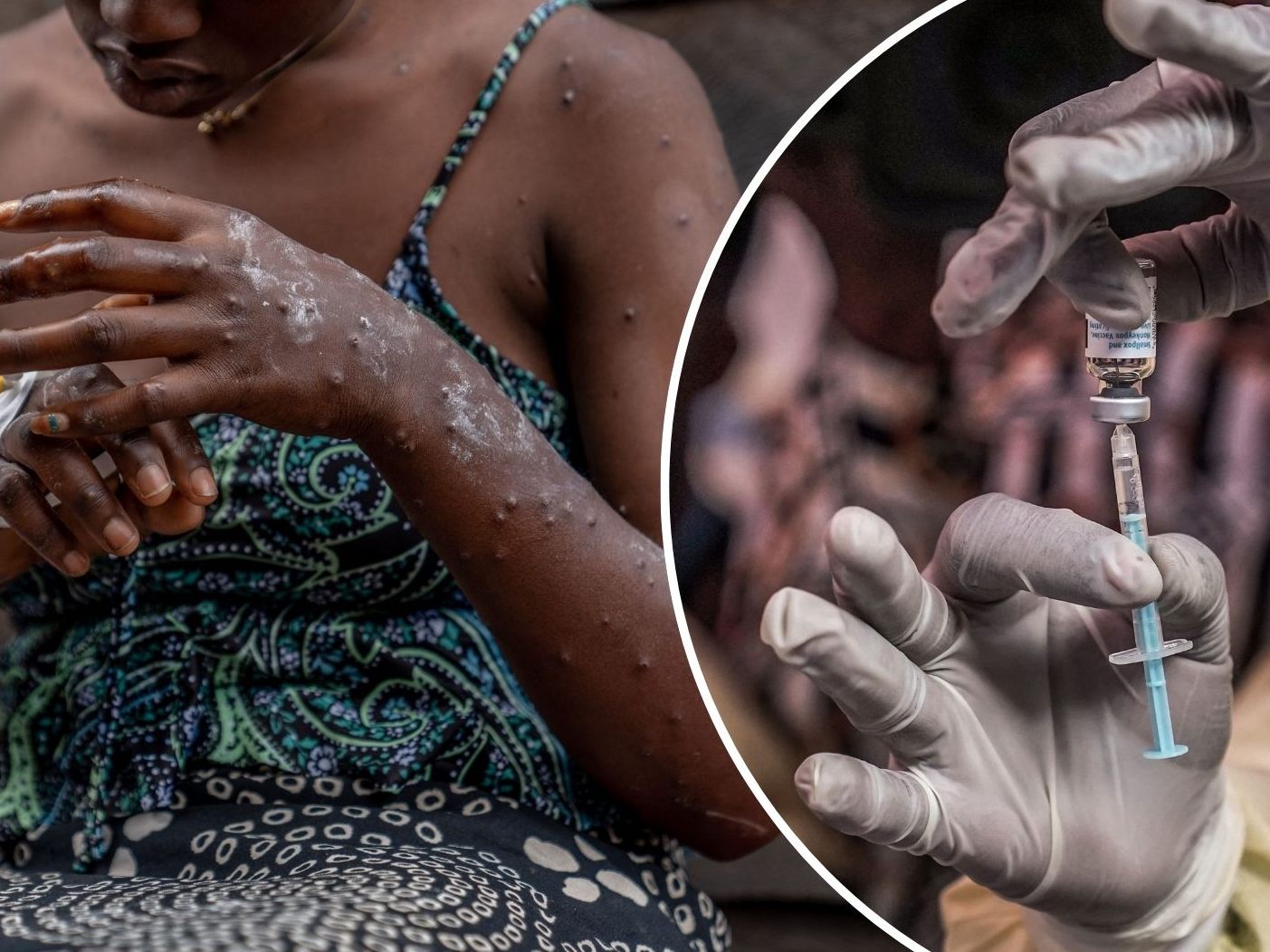 Hunderte Mpox-Patienten im Ostkongo ohne weitere Behandlung geflohen