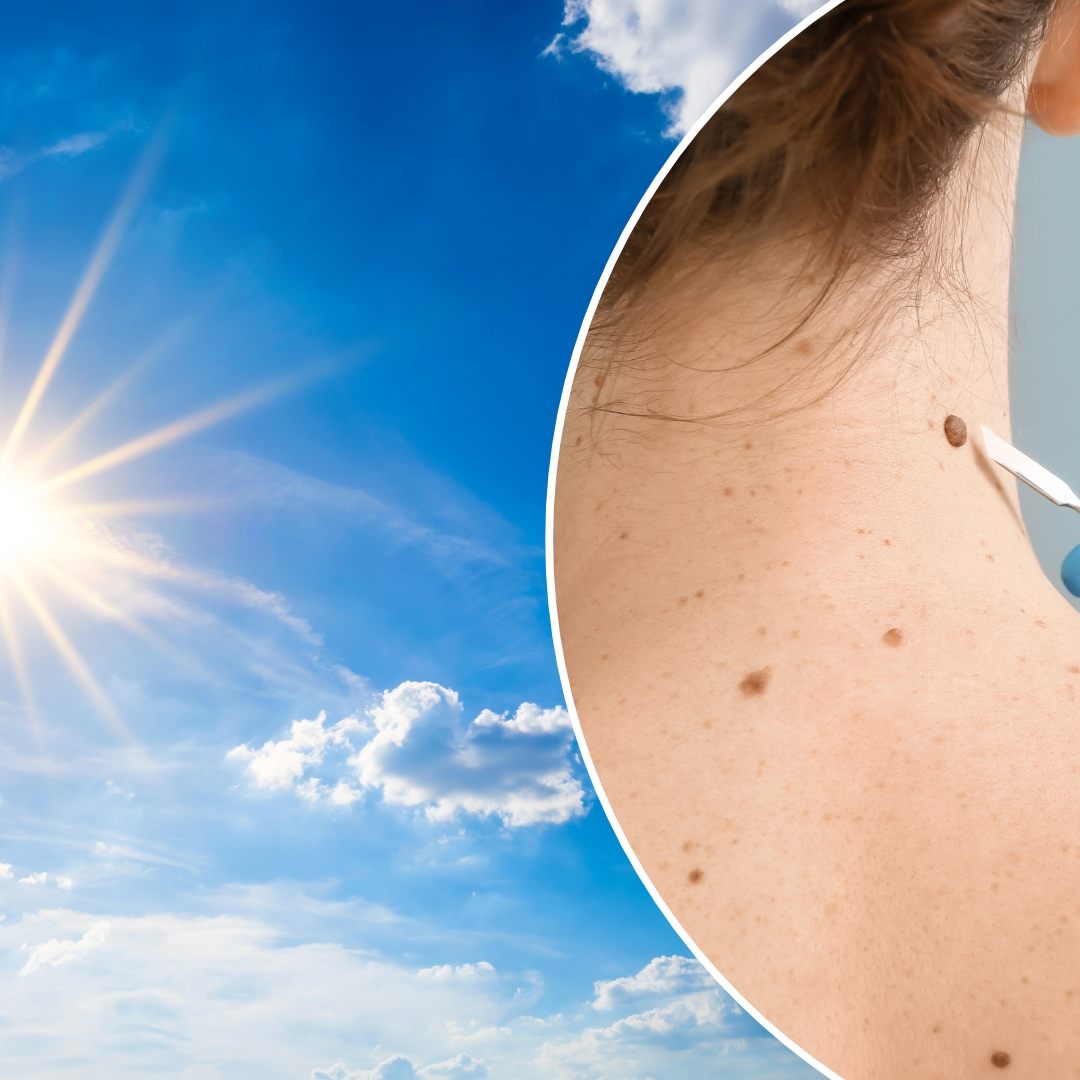 Die Klimakrise hat massive Auswirkungen auf die Gesundheit - u. a. auch auf die Haut.