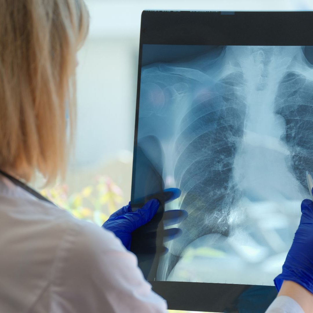 80 Prozent der Erkrankungen in London im Frühstadium entdeckt