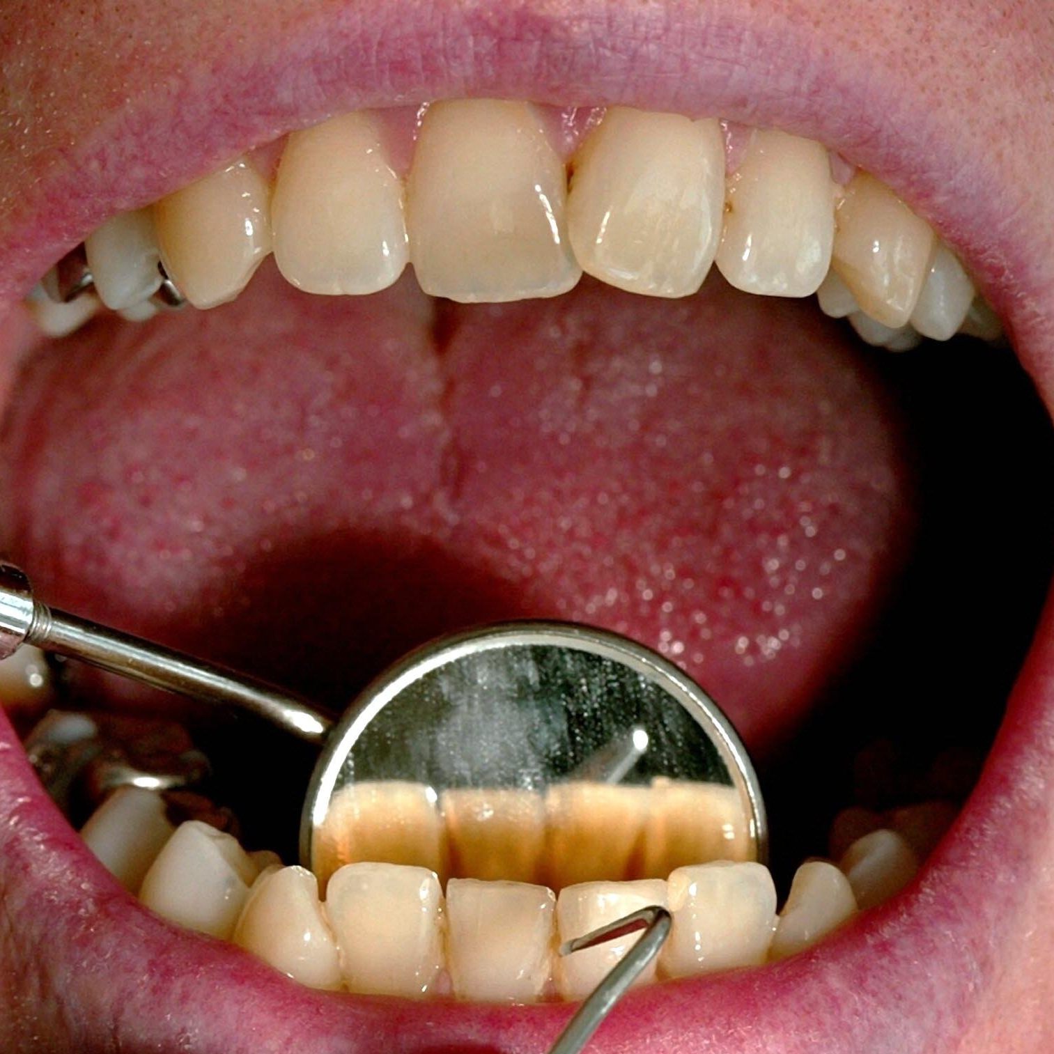 Neue Nebenwirkung entdeckt: "Ozempic-Zähne" alarmieren Zahnärzte.