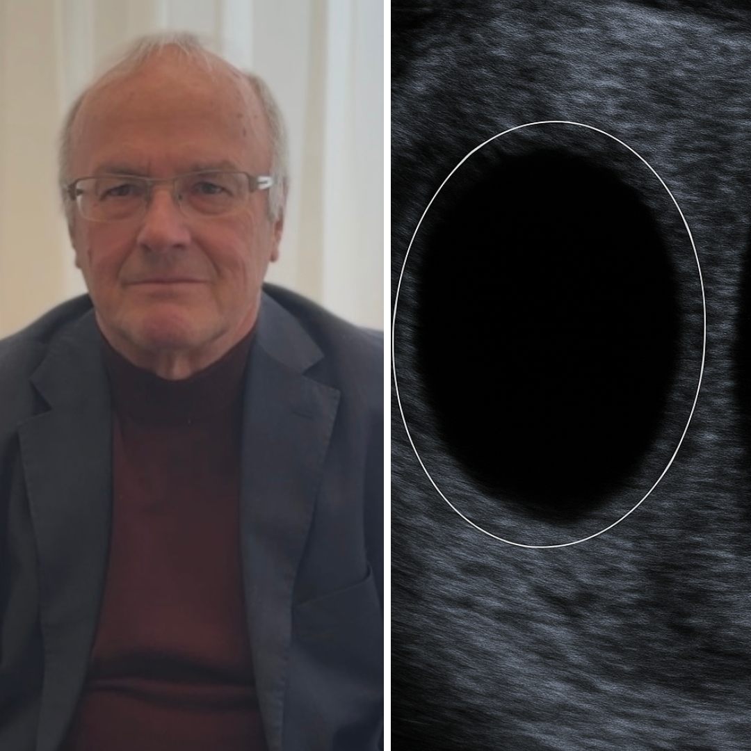 Das "Vanishing Twin Syndrome" ist in der psychologie ein sehr umstrittenes Thema.