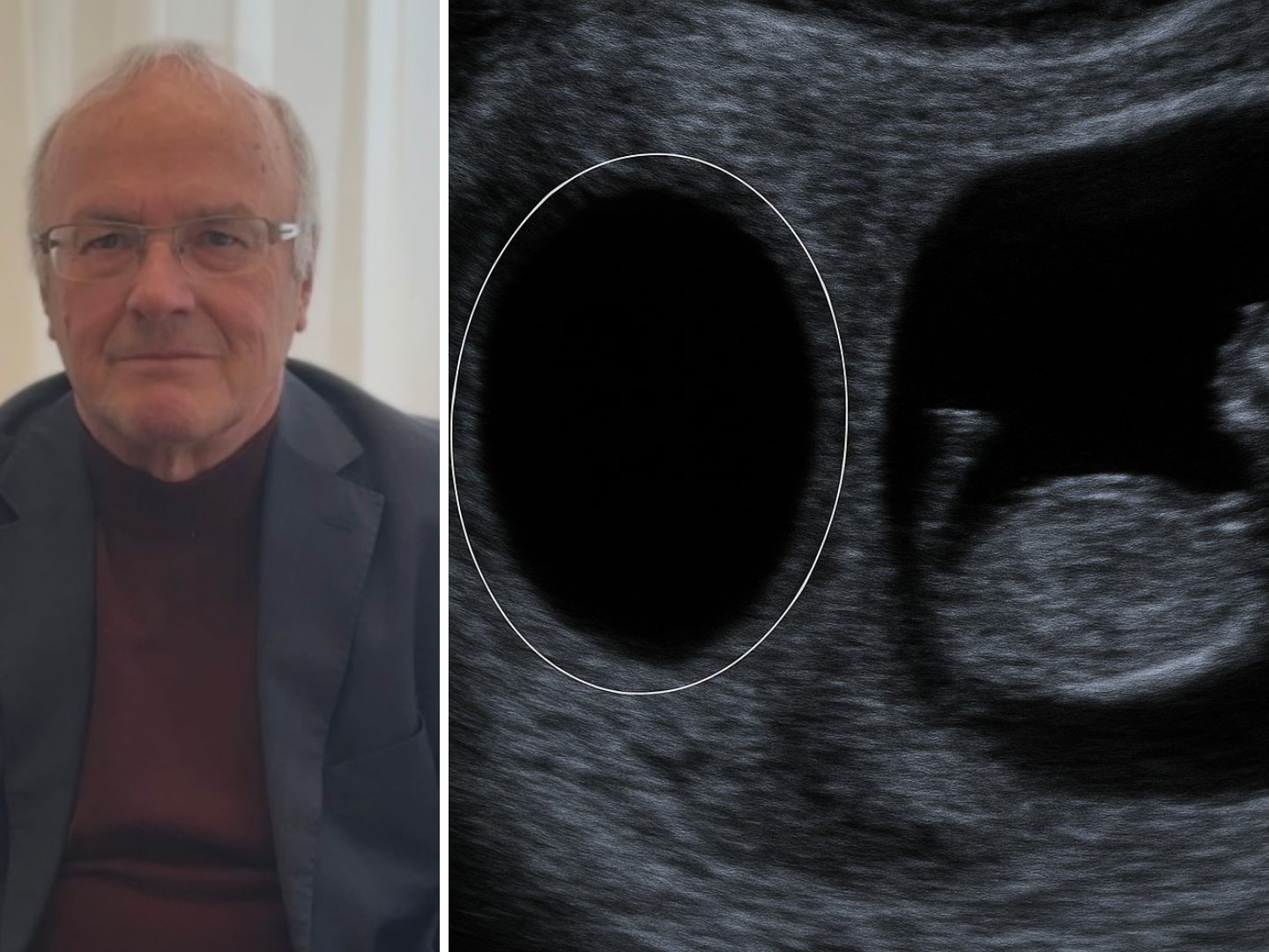 Das "Vanishing Twin Syndrome" ist in der psychologie ein sehr umstrittenes Thema.