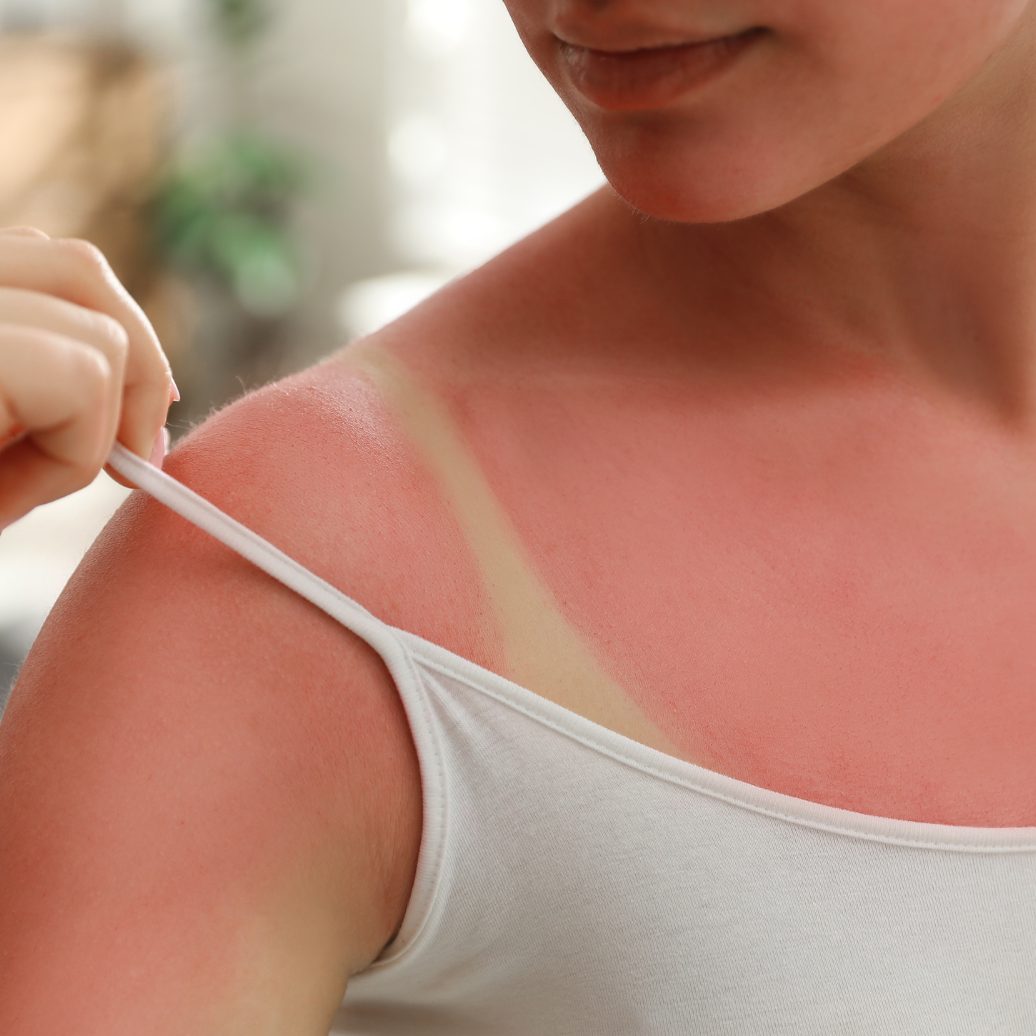 Tipps gegen Sonnenbrand.