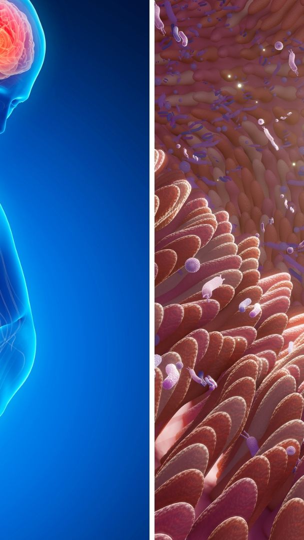 Chronisch-entzündliche Darmerkrankungen nehmen weltweit zu.