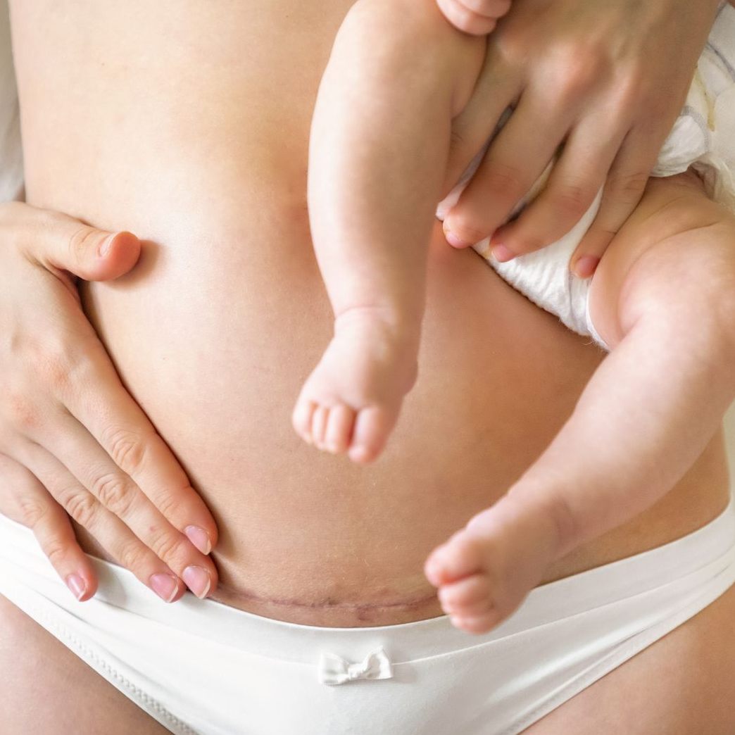 Der Anteil an Kaiserschnitten ist seit 1995 von 12,4 auf 32,5 Prozent gestiegen.