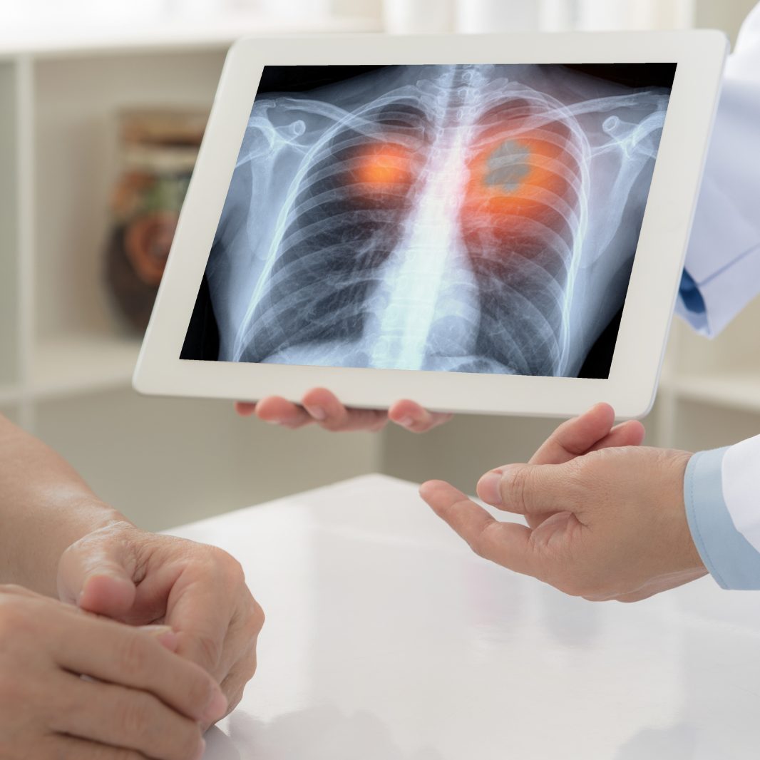 In fünf Sekunden zur Lungenkrebs-Früherkennung.