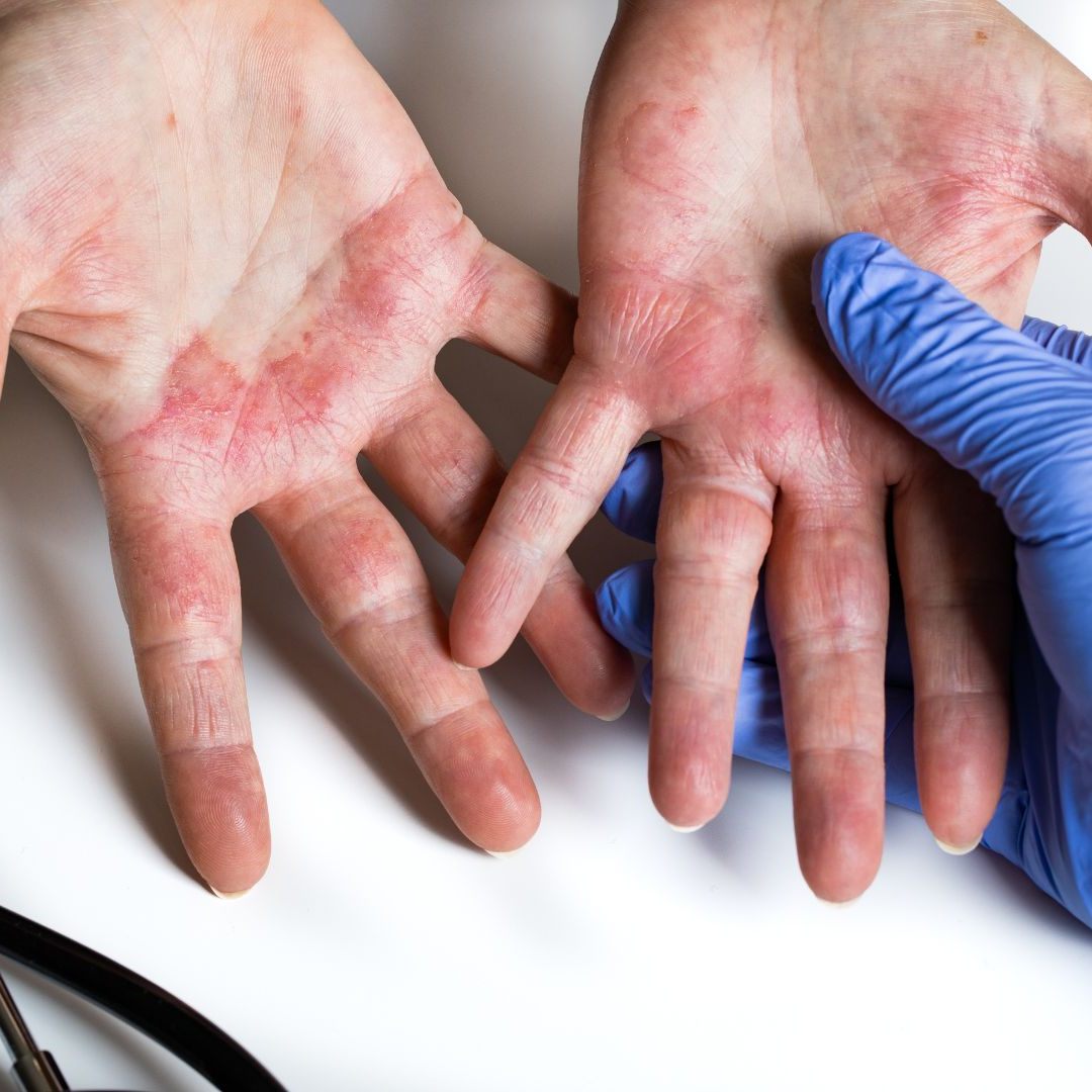 Bei Verwendung des Nagellackentferners kann es zu Rötungen und Bläschenbildung kommen.