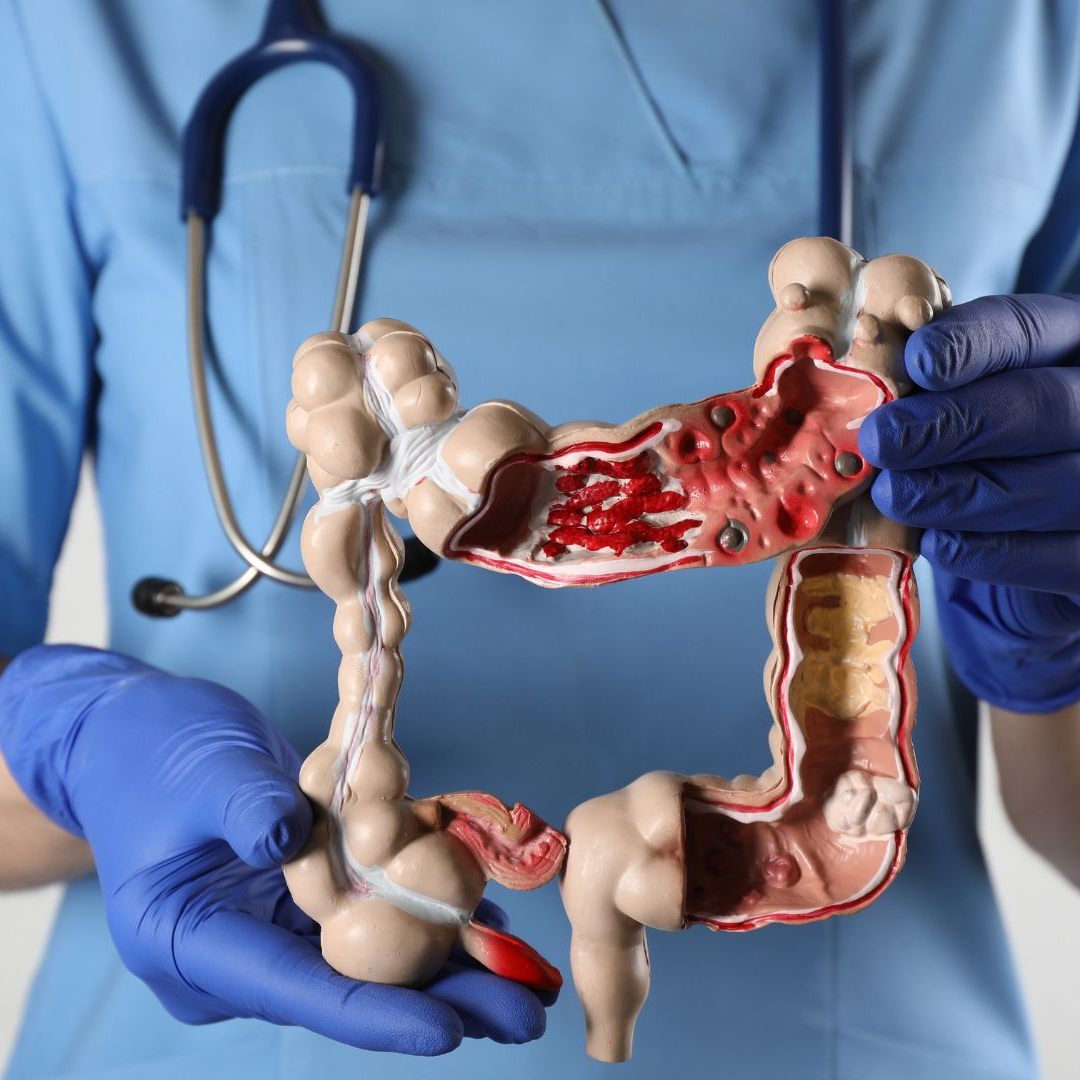 Eine frühzeitige Untersuchung kann die Entstehung von Darmkrebs womöglich verhindern.