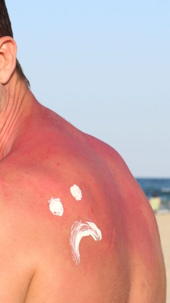 Sonne zu stark? Diese SOS-Tipps helfen sofort bei Sonnenbrand.