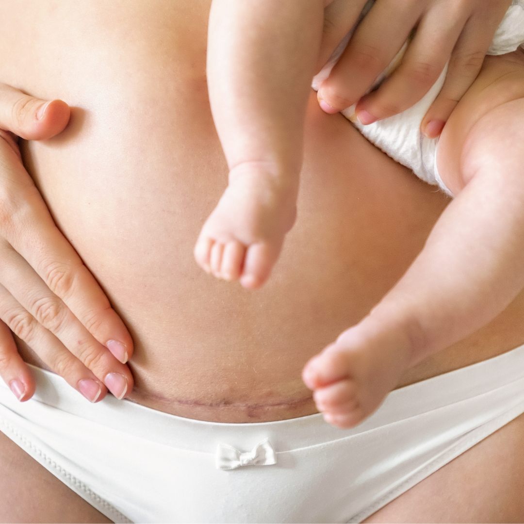 Alles rund um den Kaiserschnitt.