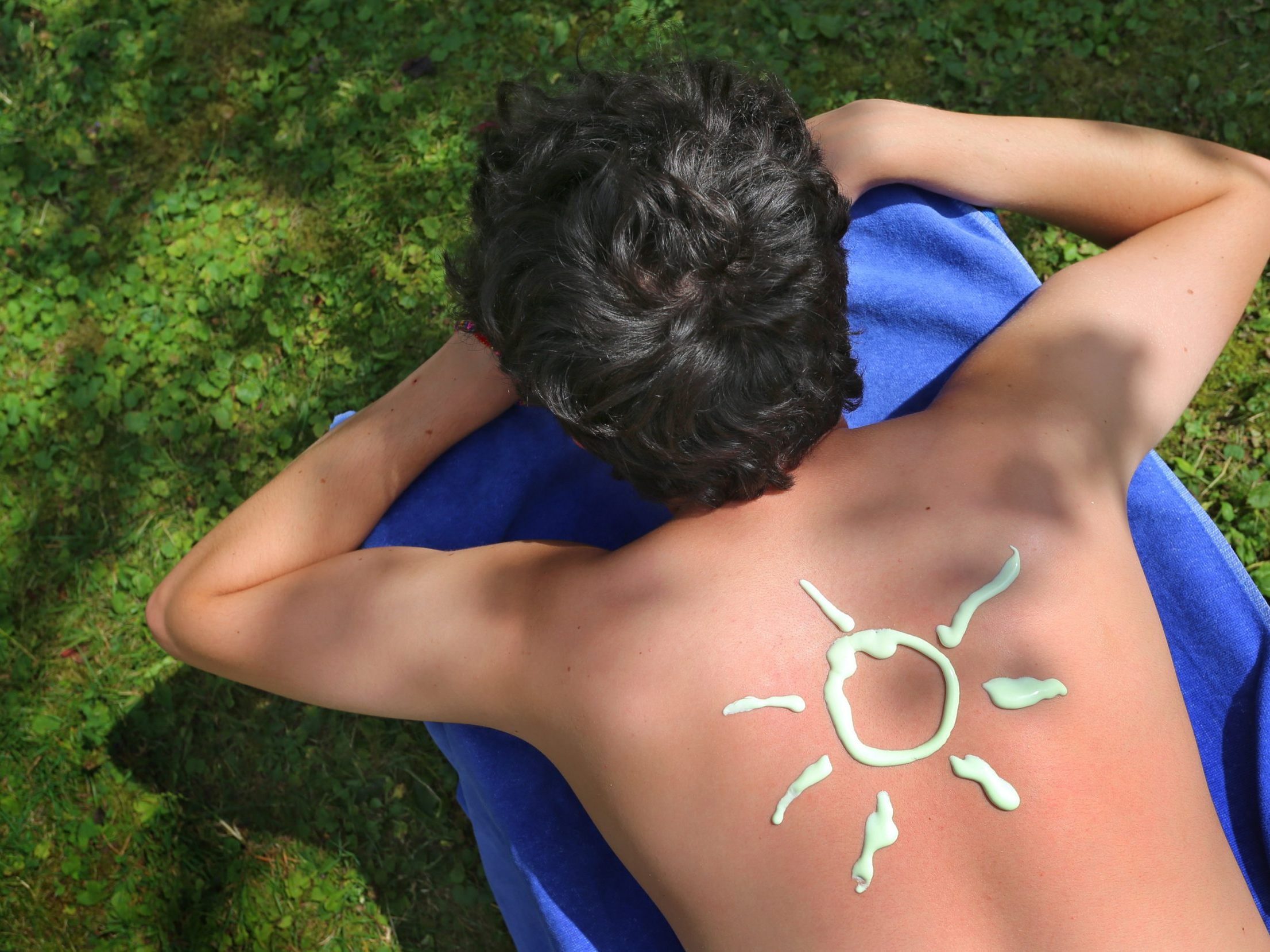 Diese Hausmittel helfen gegen Sonnenbrand.