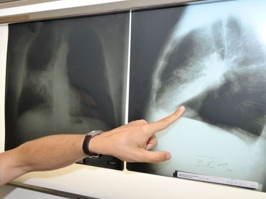 Digitale Information verbessert Lungenkrebs-Früherkennung Digitale Information verbessert Lungenkrebs-Früherkennung