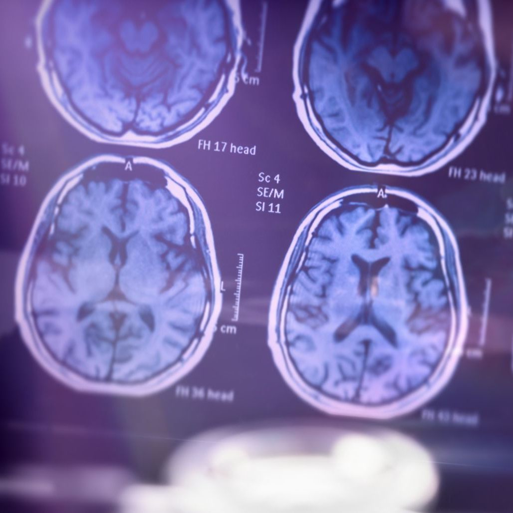 Krebs und Schlaganfall weiterhin gefürchteter als Alzheimer (Symbolbild)