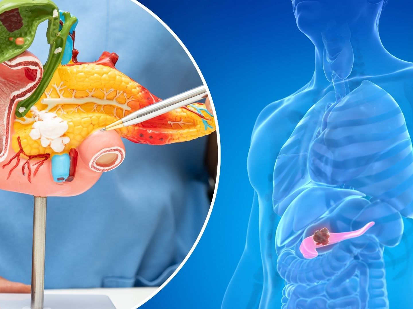 Bauchspeicheldr-senkrebs-Welche-Beschwerden-Sie-ernst-nehmen-sollten