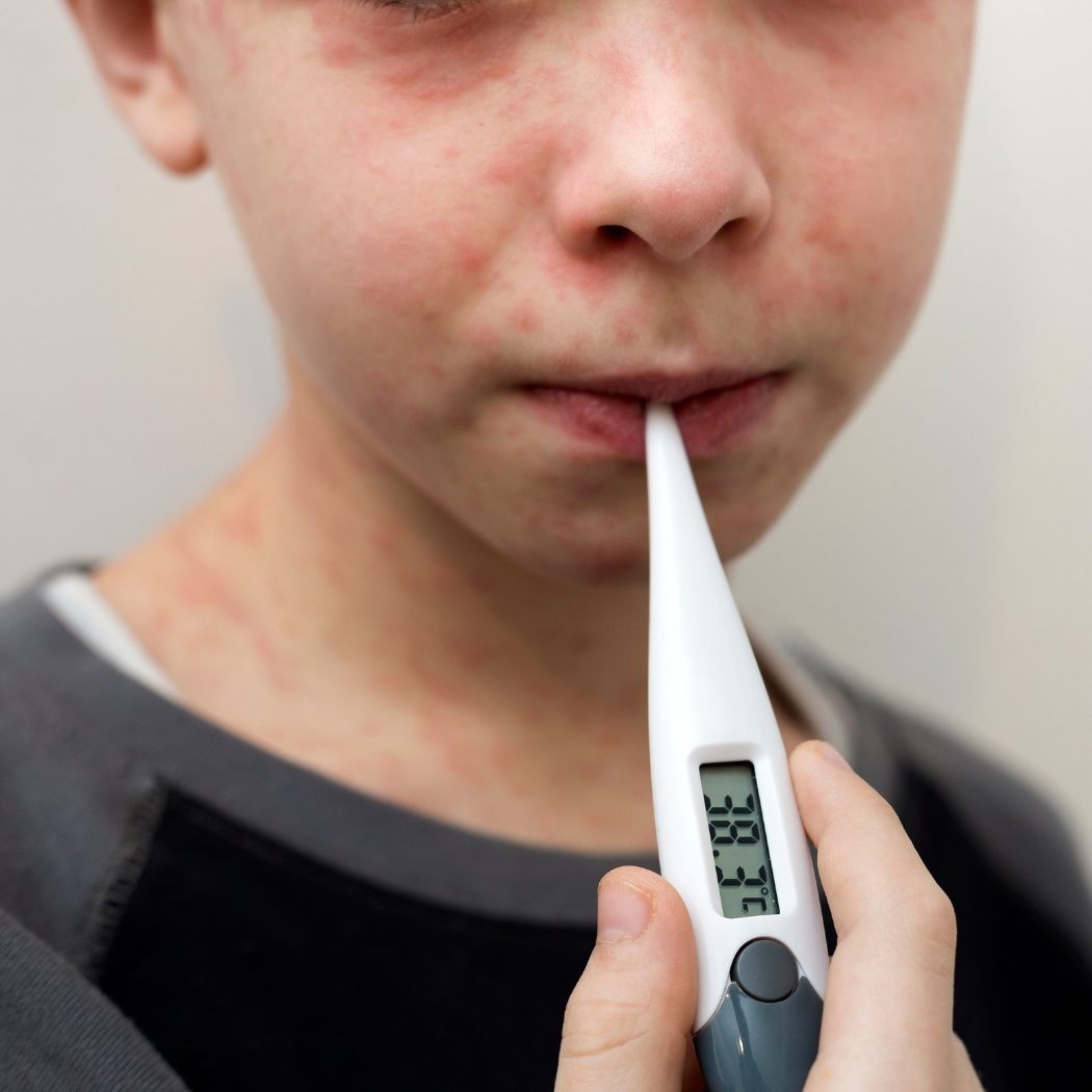 Masernfall in Erding – Gäste sollen Impfschutz prüfen. (Symbolbild)